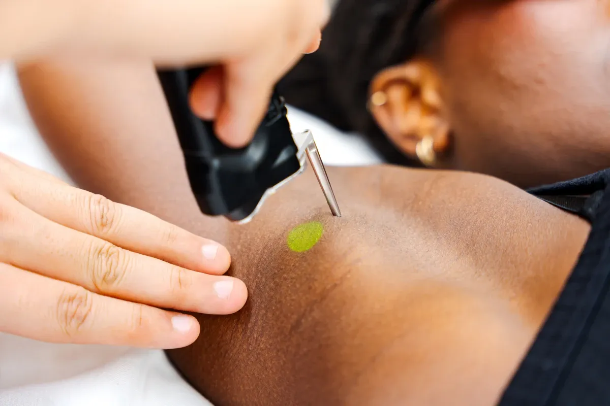 Epilation laser Mantes la Jolie 78200