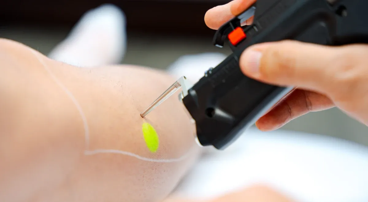 Laser ND:YAG laser Mantes-la-Jolie 78200